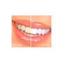 14.9 - Σύστημα Λεύκανσης Δοντιών 3ml